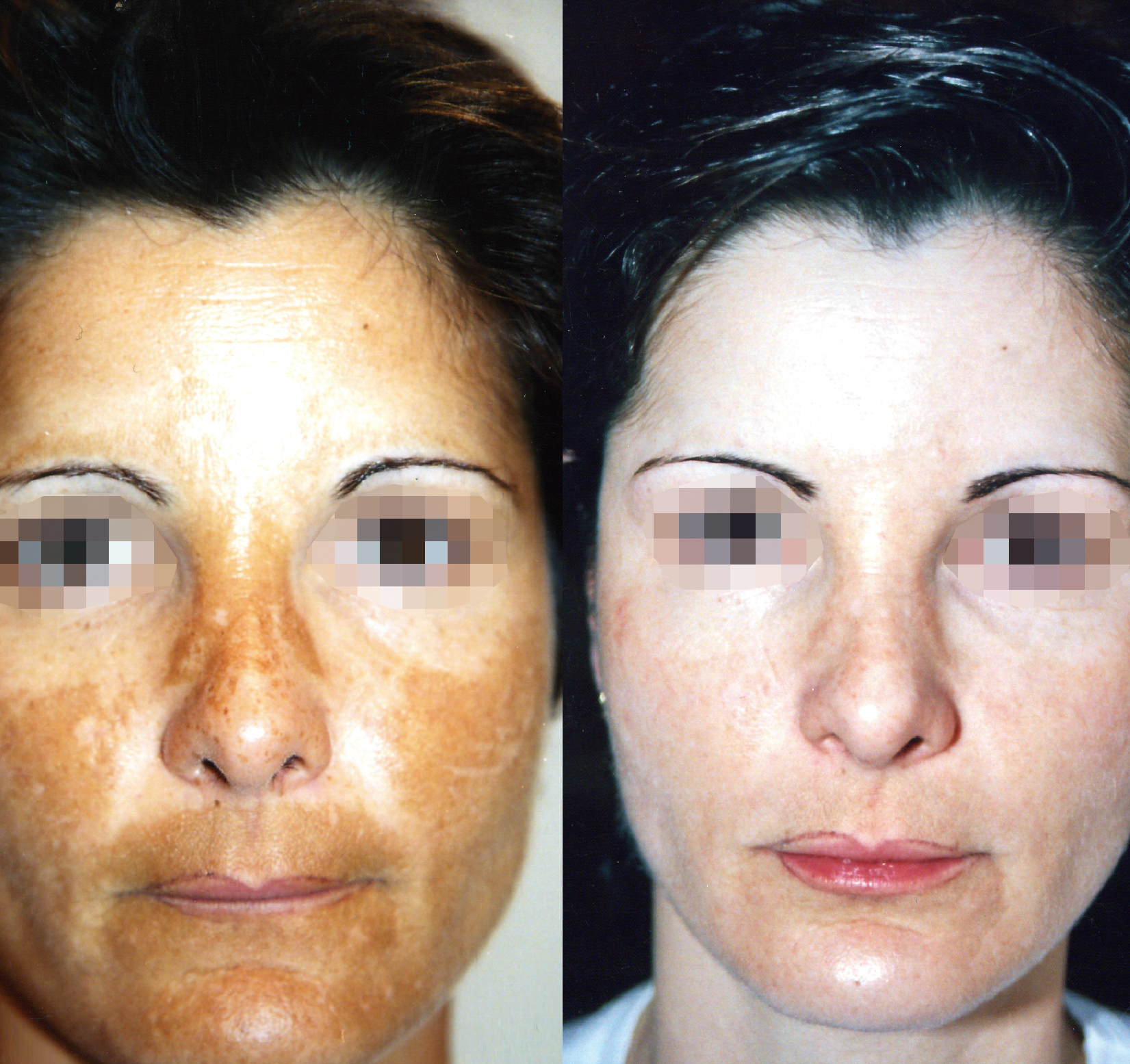 Pigmentation peel before after month 2
