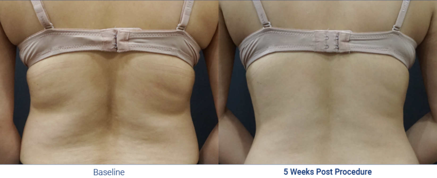 Flanks fat freezing before after