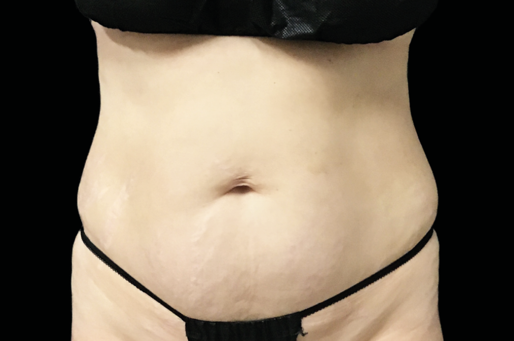 Abdomen after EMSculpt NEO