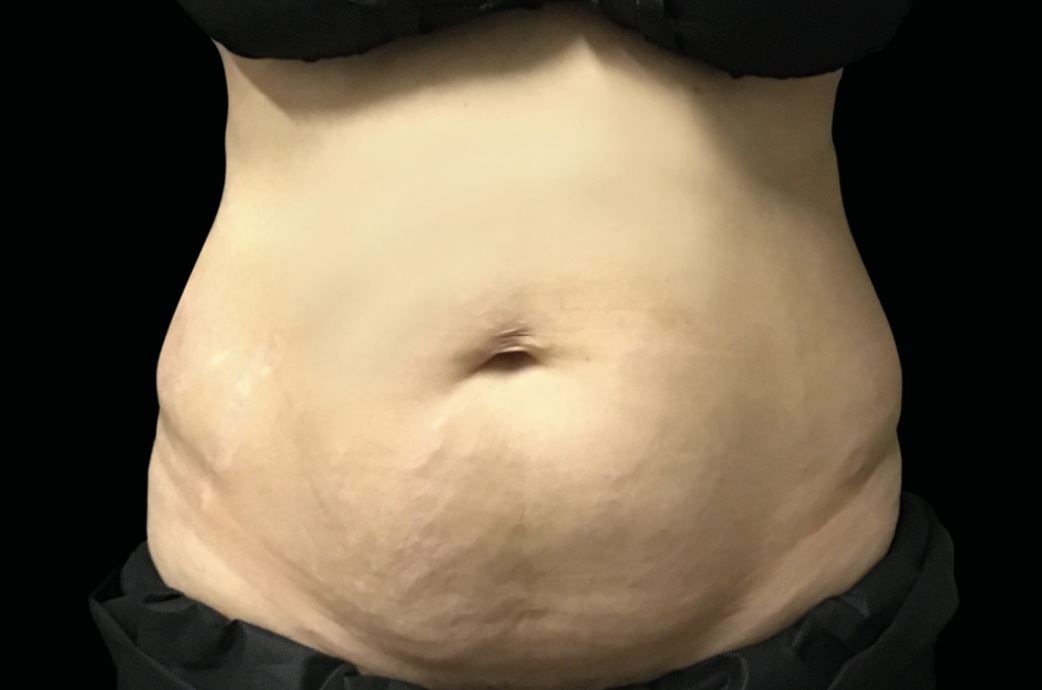 Abdomen before EMSculpt NEO