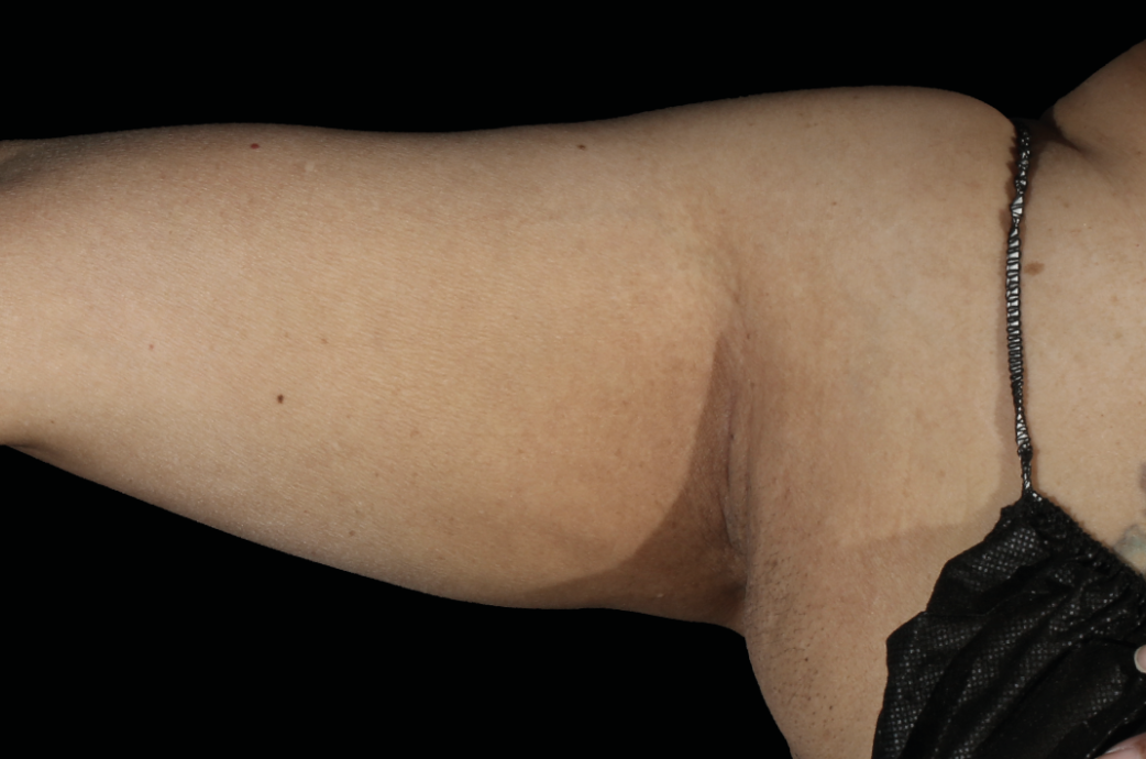 Arms after EMSculpt NEO