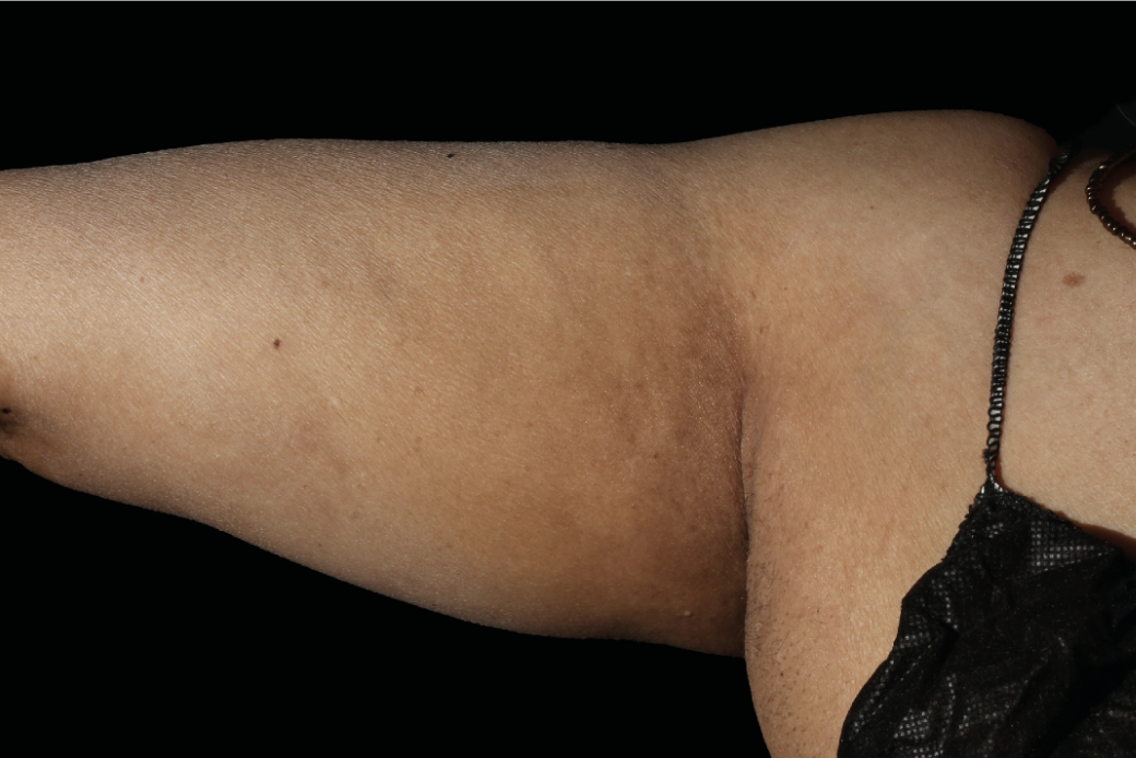 Arms before EMSculpt NEO