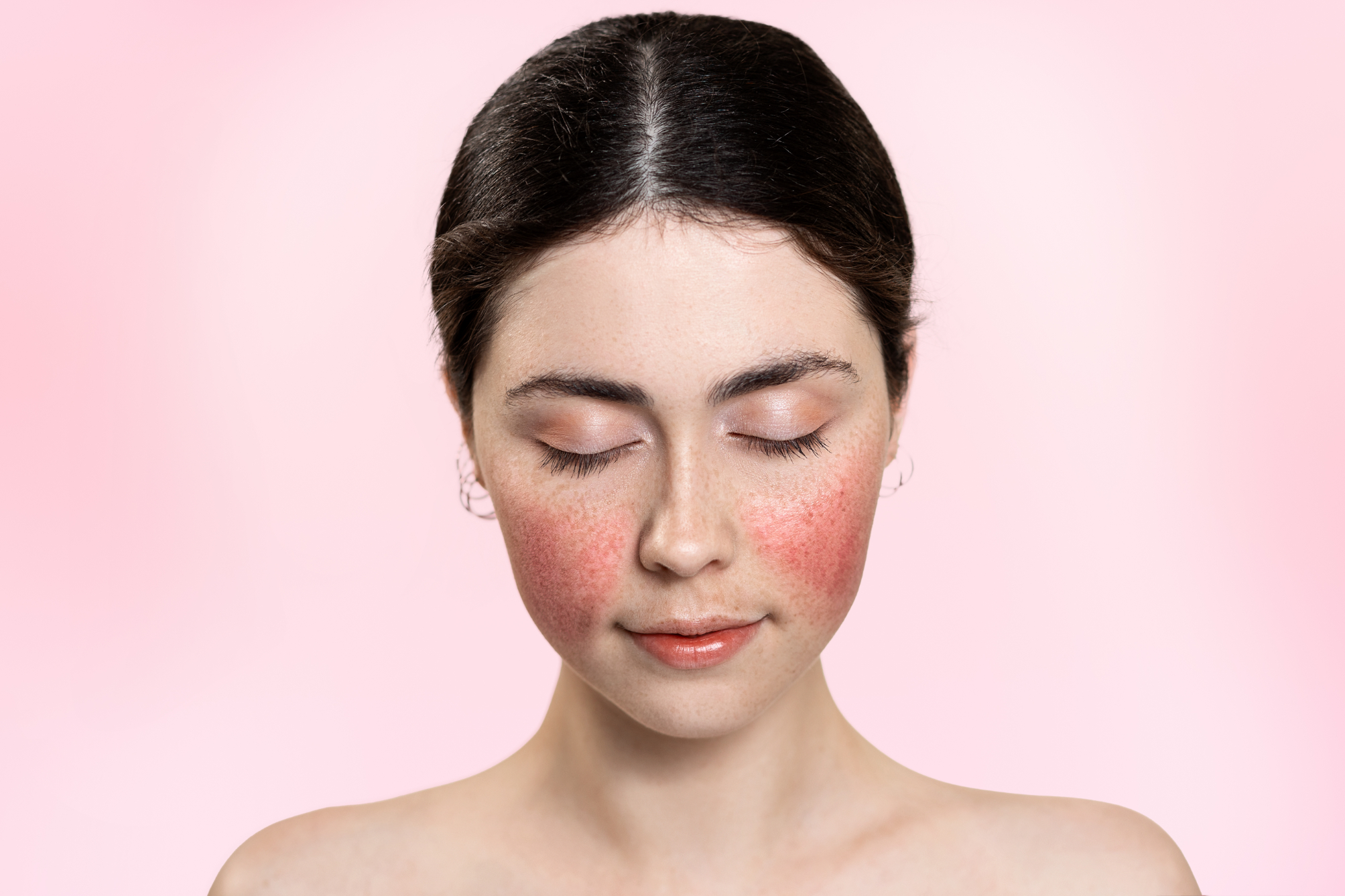 Unlocking The Secrets Of Effective Rosacea Treatment