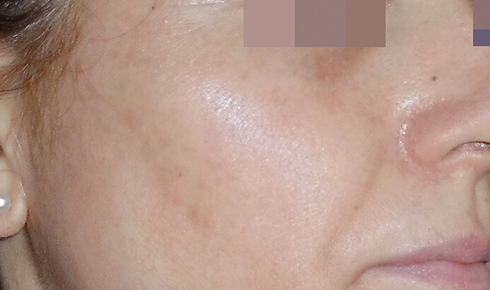 After Cosmelan peel