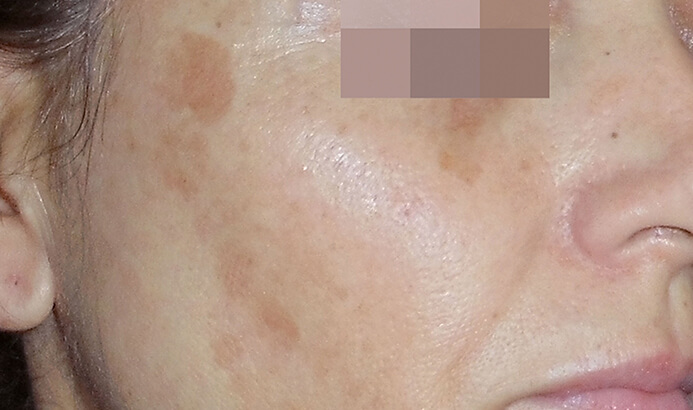 Before Cosmelan peel