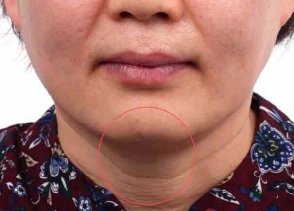 Face after Ultraformer III