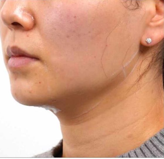 After Ultraformer III, chin and neck, EF MEDISPA London