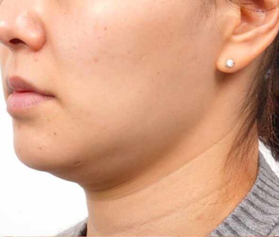 Before Ultraformer III, chin and neck, EF MEDISPA London