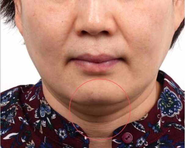 Face before Ultraformer III